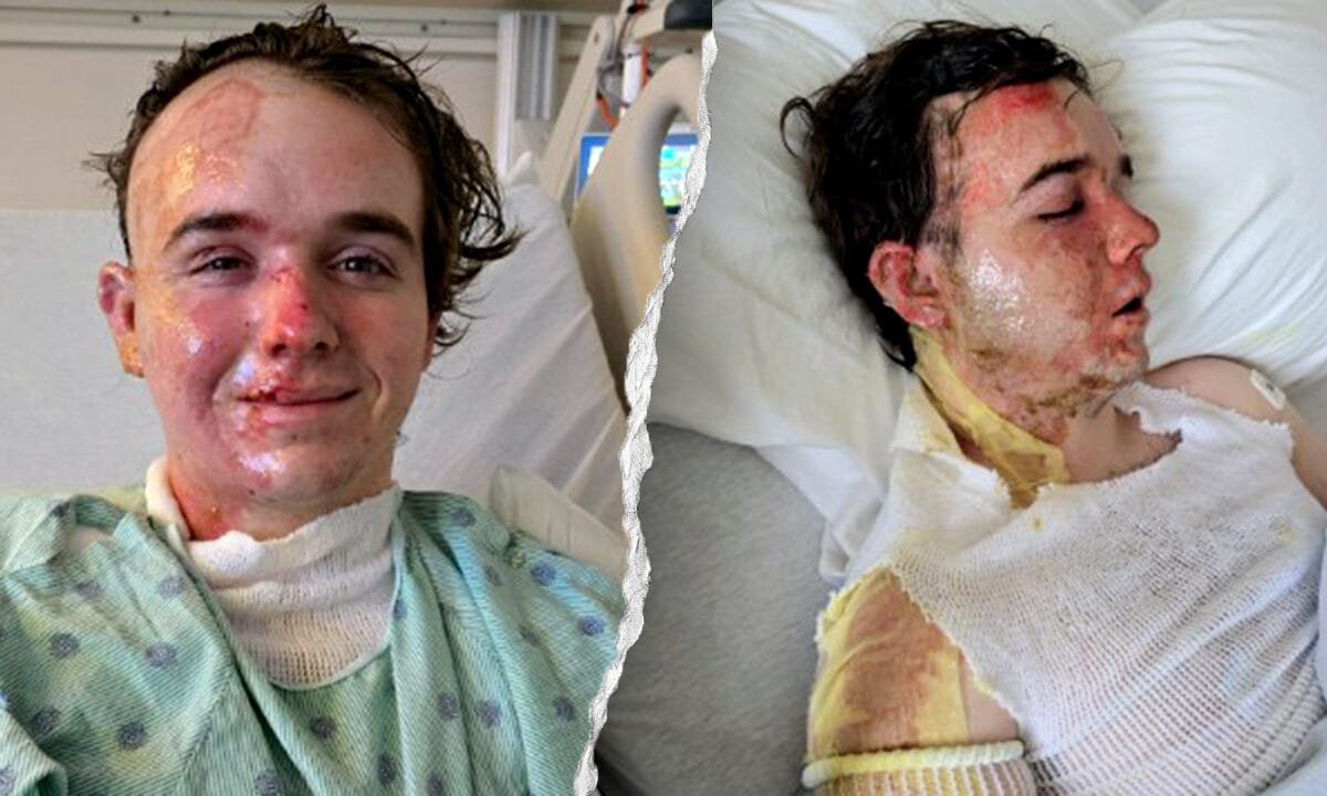 McDonald’s worker allegedly doused with hot cooking oil by co-worker, suffers burns over 22% of his body